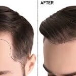 Body Hair Transplant Clinic in Delhi Offers Advanced Hair Restoration Solutions